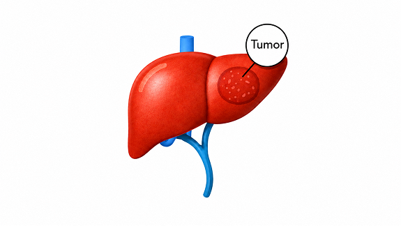 Carcinoma-hepatoceluullar