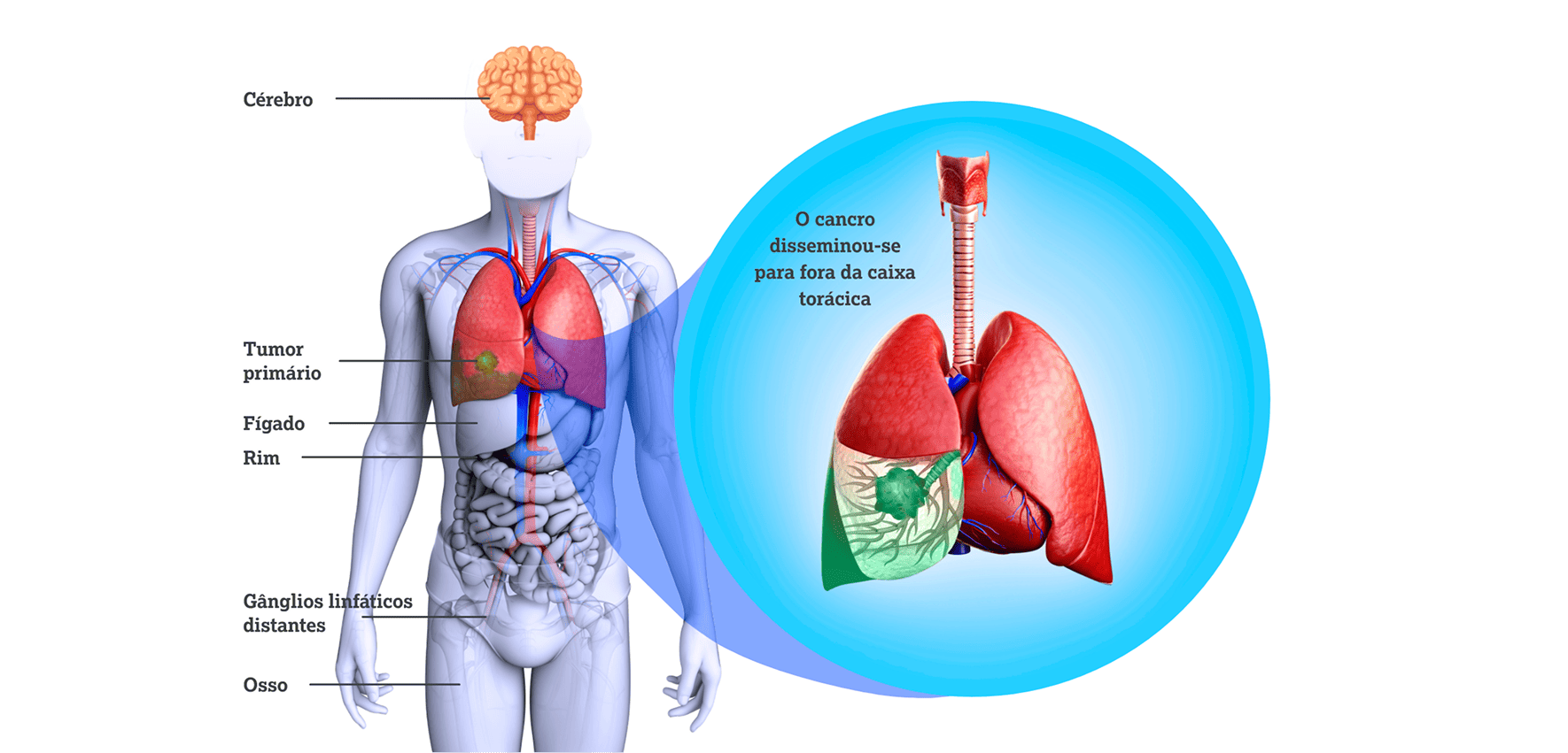 Compreender os Estádios do Cancro do Pulmão